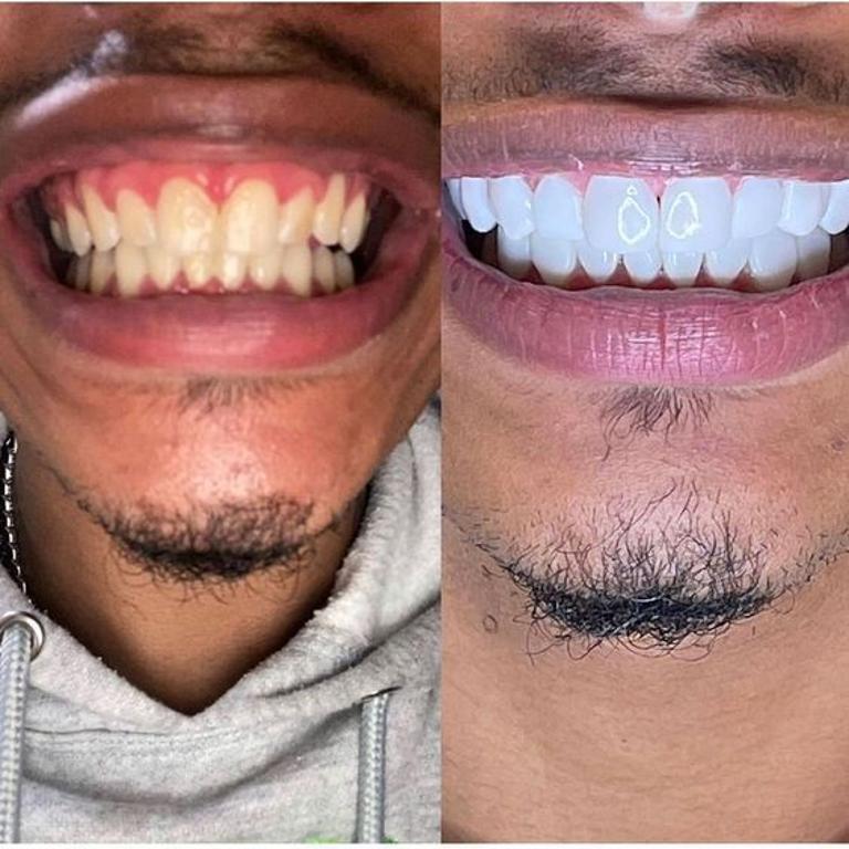 V34 Whitening Strips